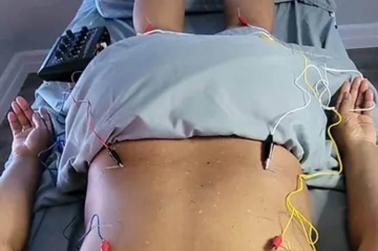 Acupuncture with Electrical Stimulation