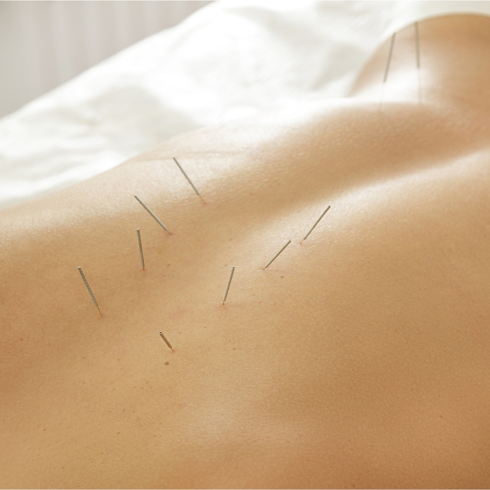 Acupuncture in Smithtown NY