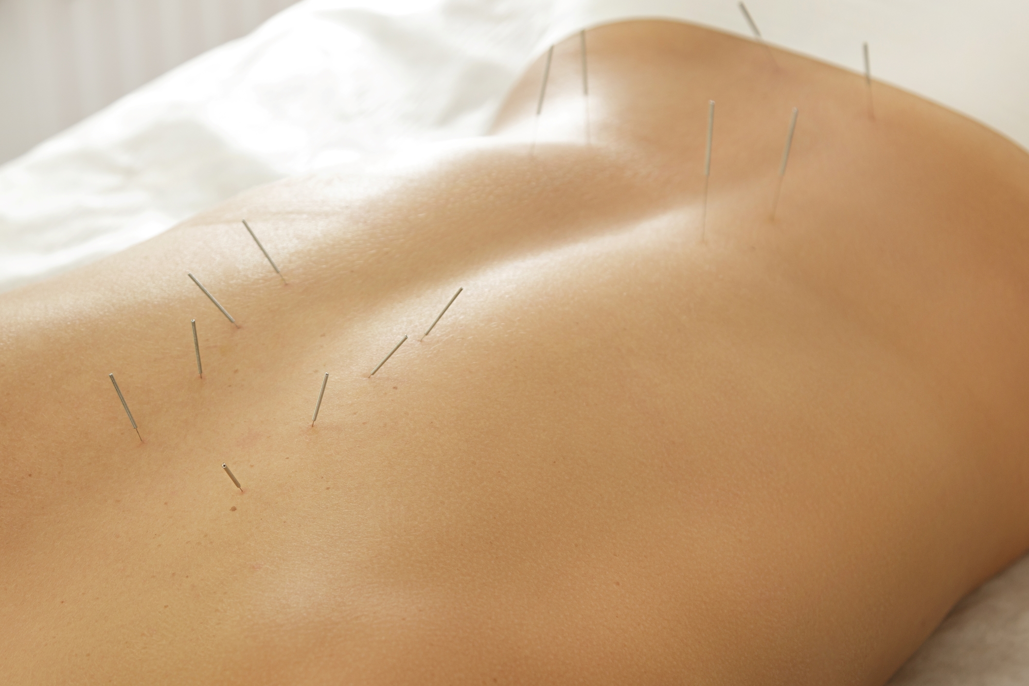 Acupuncture in Smithtown